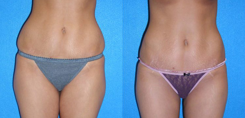 Abdomen & Flanks VASER Liposuction Sacramento