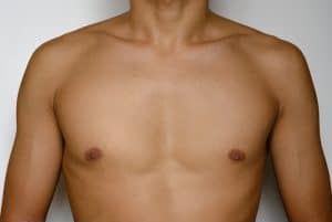 Gynecomastia surgery in Sacramento